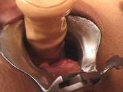 Uretra Insertion