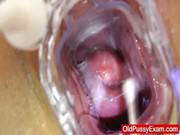 Gyno Tool Action During A Matured Gyno